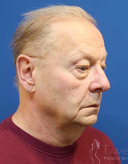 Neck Lift Before & After Patient #1487