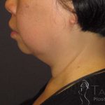Neck Lift Before & After Patient #1498