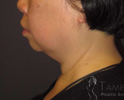 Neck Lift Before & After Patient #1498