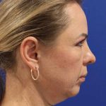 Neck Lift Before & After Patient #1538