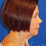 Neck Lift Before & After Patient #1578