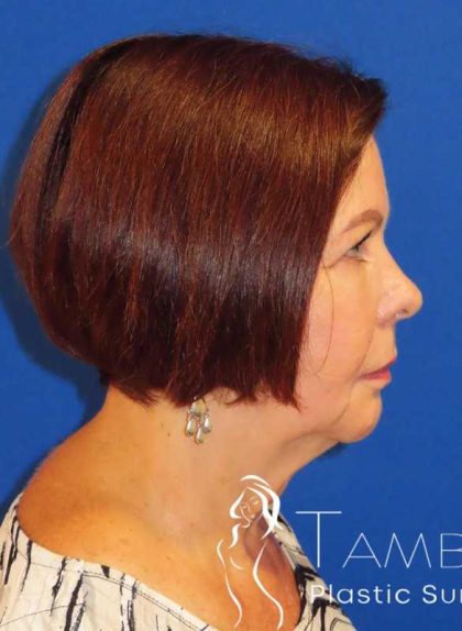 Neck Lift Before & After Patient #1578