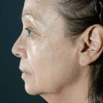 Chemical Peel Before & After Patient #429