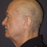Facelift Before & After Patient #1675