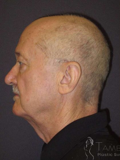 Facelift Before & After Patient #1675
