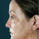 Facelift Before & After Patient #1682
