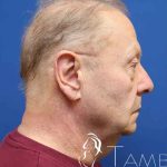Facelift Before & After Patient #1693