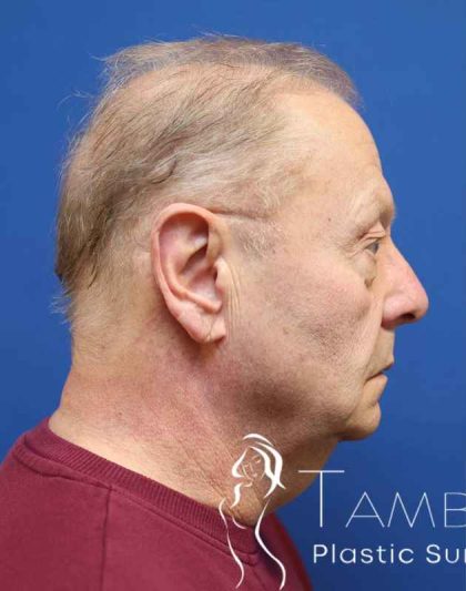 Facelift Before & After Patient #1693