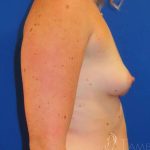 Breast Augmentation Before & After Patient #2000