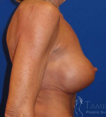 Breast Augmentation Before & After Patient #2011