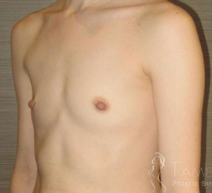Breast Augmentation Before & After Patient #2081