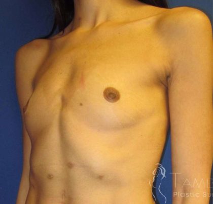 Breast Augmentation Before & After Patient #2108