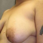 Breast Augmentation Before & After Patient #2152