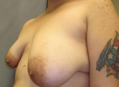 Breast Augmentation Before & After Patient #2152