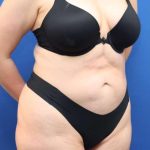 Lower Body Lift Before & After Patient #598