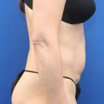 Liposuction Before & After Patient #652