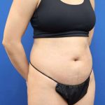 Liposuction Before & After Patient #668