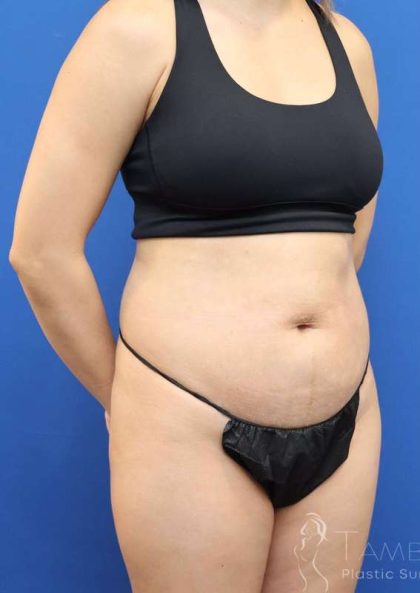 Liposuction Before & After Patient #668