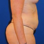 Liposuction Before & After Patient #702