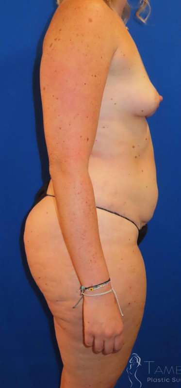 Liposuction Before & After Patient #702