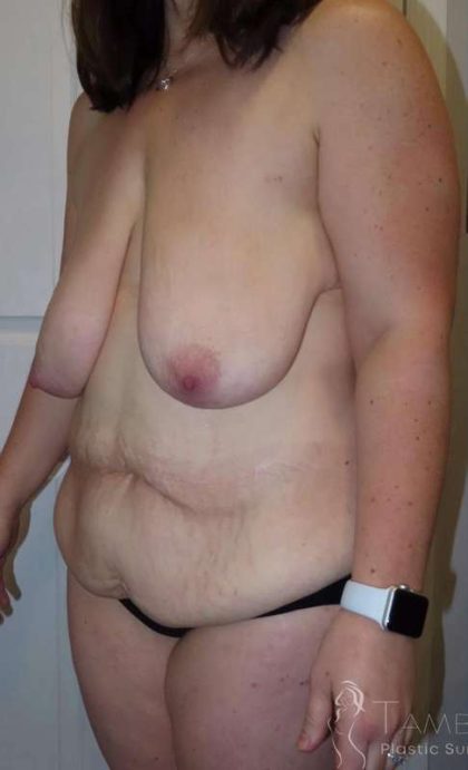 Liposuction Before & After Patient #742