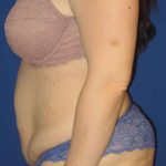 Liposuction Before & After Patient #758