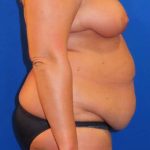 Liposuction Before & After Patient #777
