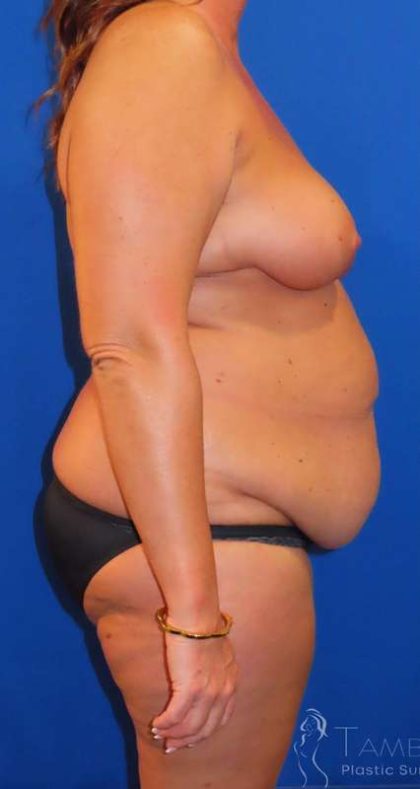 Liposuction Before & After Patient #777
