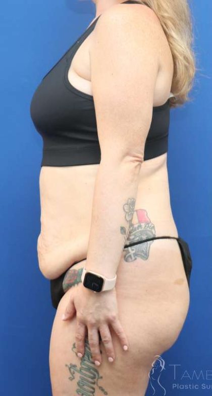 Liposuction Before & After Patient #852