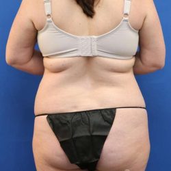 Brazilian Butt Lift Before & After Patient #906