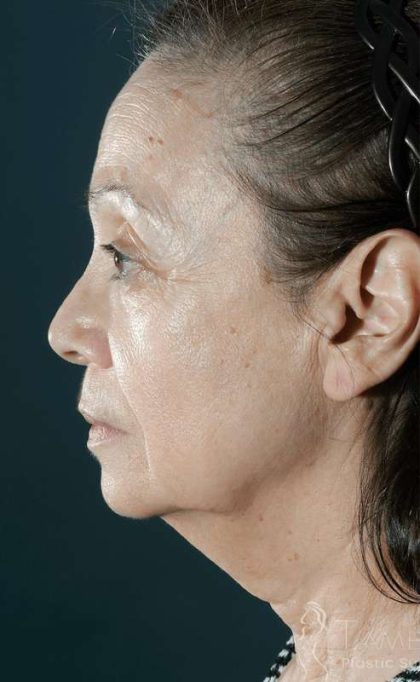 Laser Skin Resurfacing Before & After Patient #422