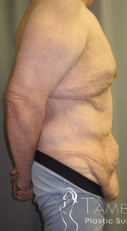 Body Contouring Before & After Patient #1004