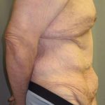 After Weight Loss Surgery Before & After Patient #1112