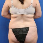 Tummy Tuck Before & After Patient #1142