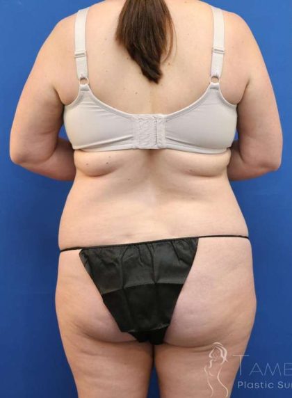 Tummy Tuck Before & After Patient #1142