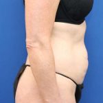 Tummy Tuck Before & After Patient #1153