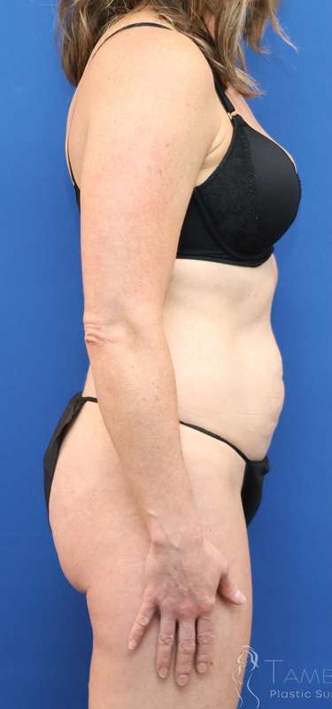 Tummy Tuck Before & After Patient #1153