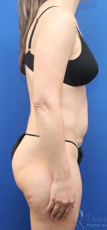 Tummy Tuck Before & After Patient #1164