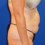 Tummy Tuck Before & After Patient #1190