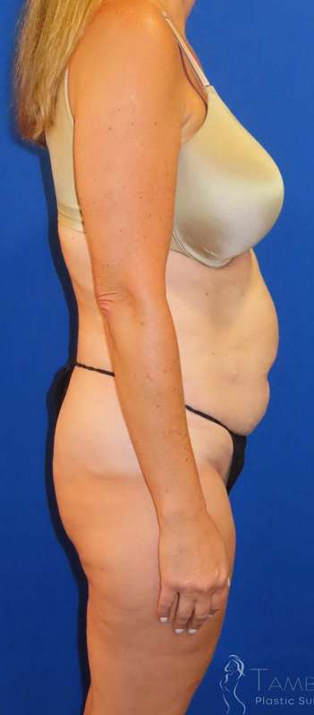Tummy Tuck Before & After Patient #1190