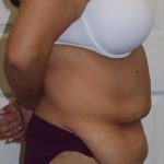 Tummy Tuck Before & After Patient #1214