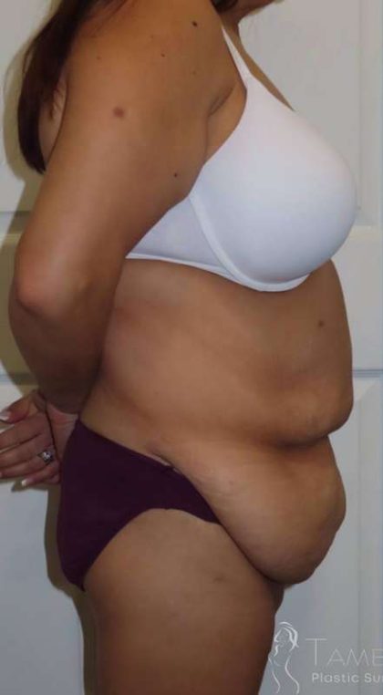 Tummy Tuck Before & After Patient #1214