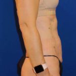 Tummy Tuck Before & After Patient #1236