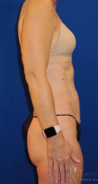 Tummy Tuck Before & After Patient #1236