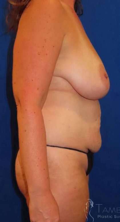 Tummy Tuck Before & After Patient #1260