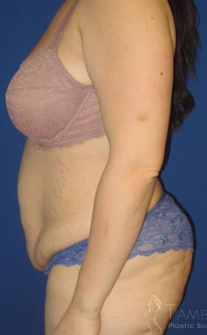 Tummy Tuck Before & After Patient #1293