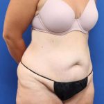 Tummy Tuck Before & After Patient #1343