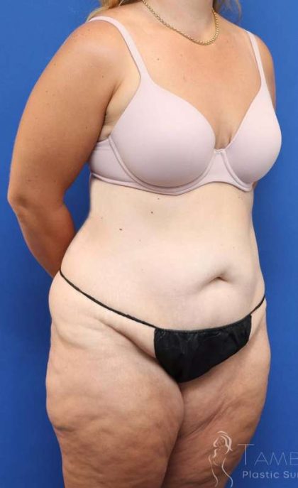 Tummy Tuck Before & After Patient #1343