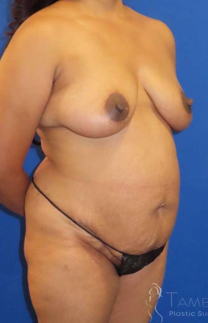 Tummy Tuck Before & After Patient #1395