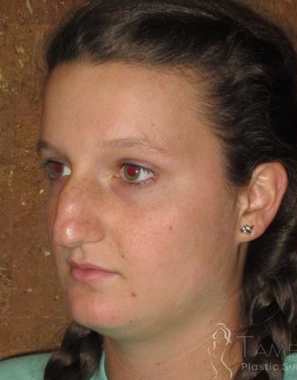 Rhinoplasty Before & After Patient #1406